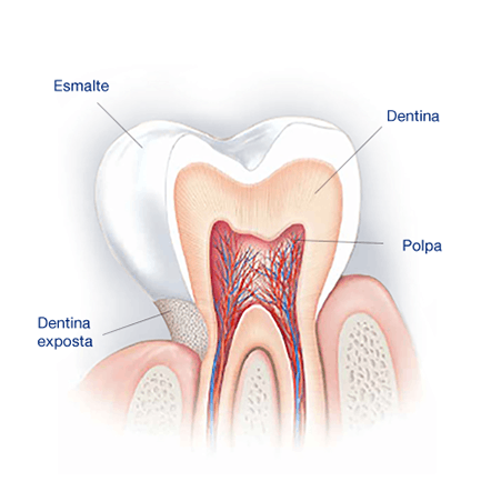 Quais são as causas dos dentes sensíveis?