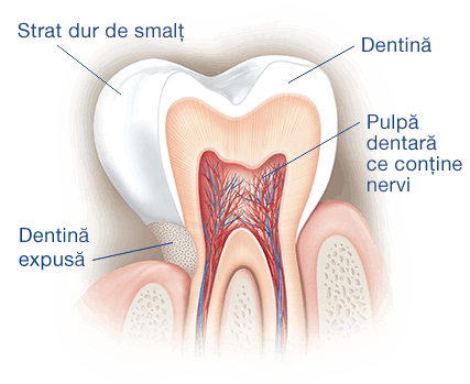 Cauze sensibilitate dentara