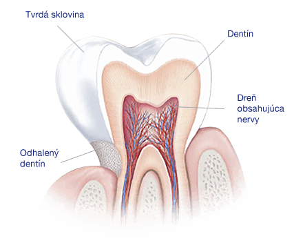 Čo spôsobuje citlivé zuby?