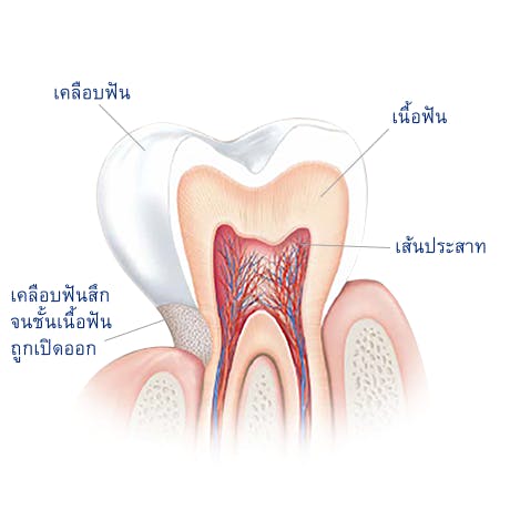 เซ็นโซดายน์ | เกี่ยวกับอาการเสียวฟัน | สาเหตุของการเสียวฟันคืออะไร?