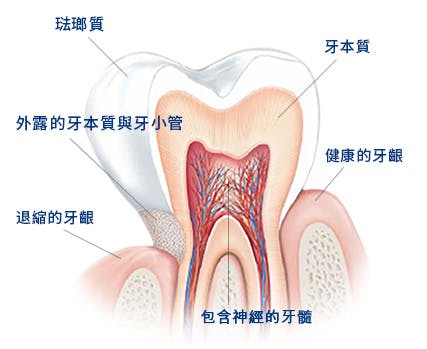 敏感性牙齒的原因：刷牙用力過度可能導致牙齒敏感酸痛 