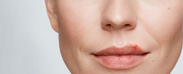 Close up of a woman with a cold sore on her lip