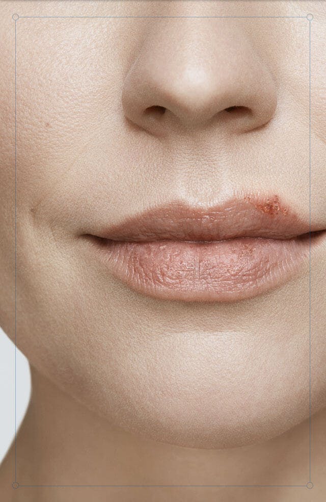 Ulcer stage face Ulcer stage face