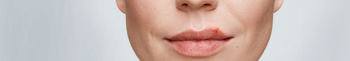 Close up of a woman with a cold sore on her lip