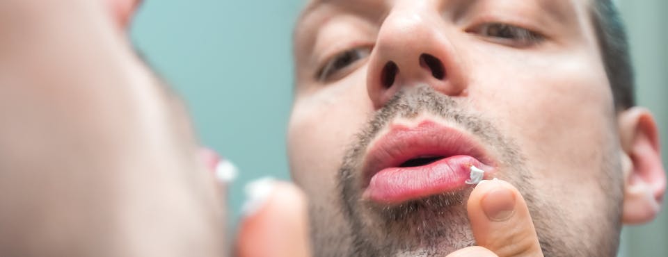 Man putting white ointment on cold sore