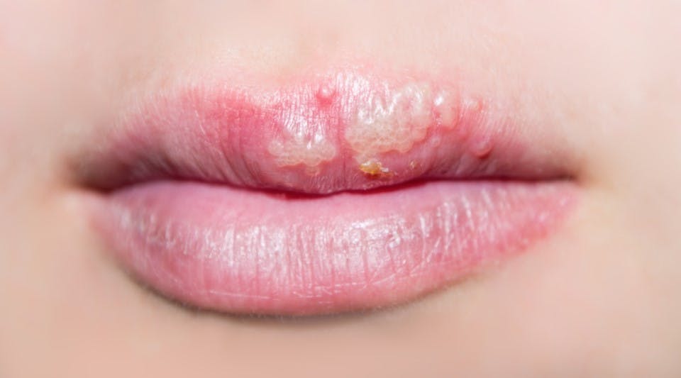 cold sores hsv 2