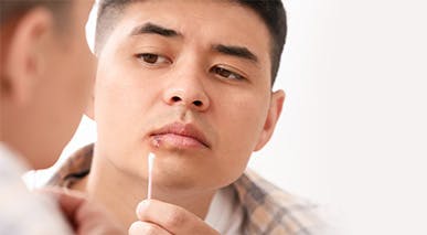 A man using a cotton swab to apply ointment to cold sores on his lips
