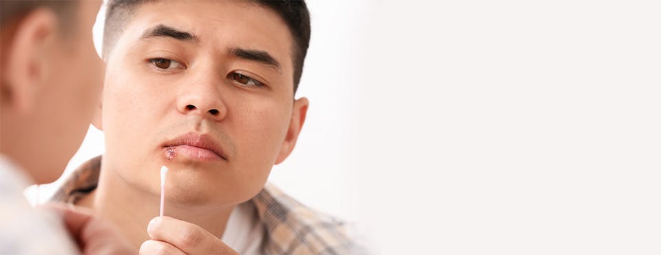 A man using a cotton swab to apply ointment to cold sores on his lips