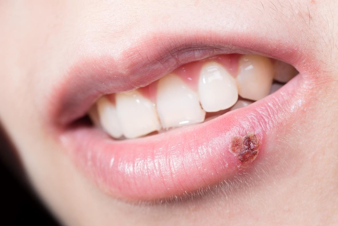 Difference Between Fever Blister And Cold Sore
