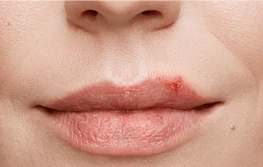 Cold sore outbreak close up