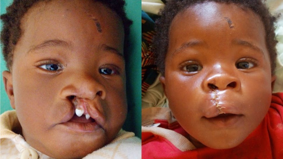 Ashuza Bahati, 11 months, before and after cleft surgery