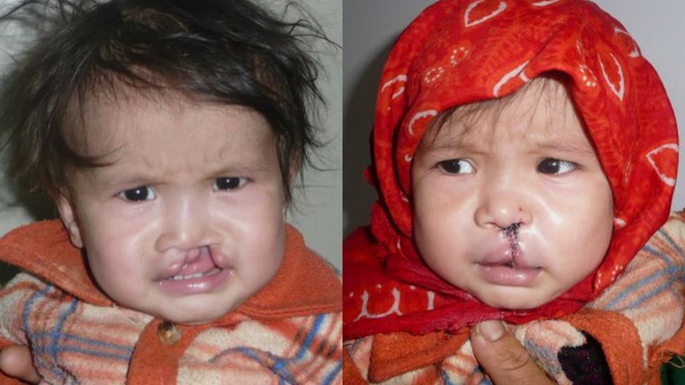 Ashuza Bahati, 11 months, before and after cleft surgery