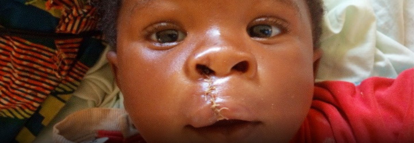 Baby with cleft lip surgery