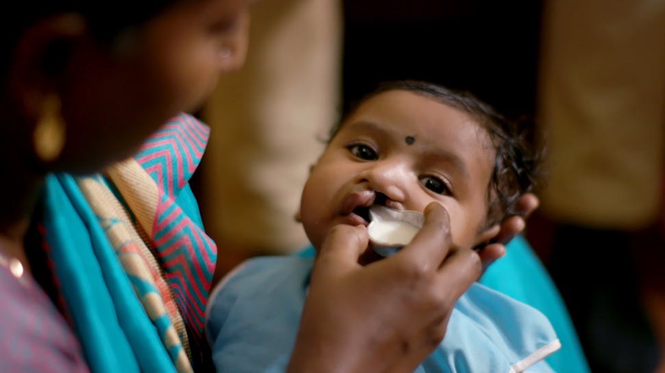 Baby with cleft lip being fed