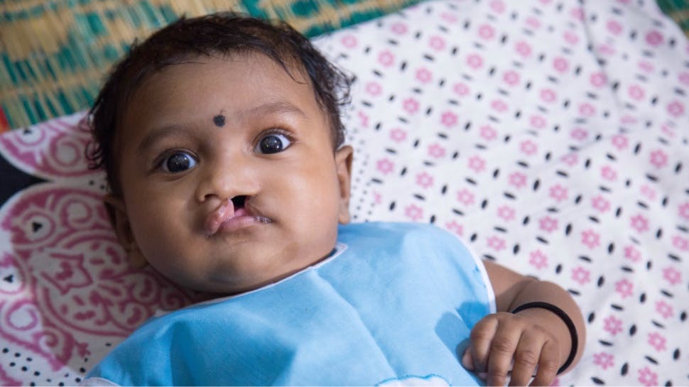 Baby with cleft lip lying on mat