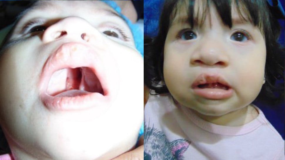 Baby before and after cleft lip surgery
