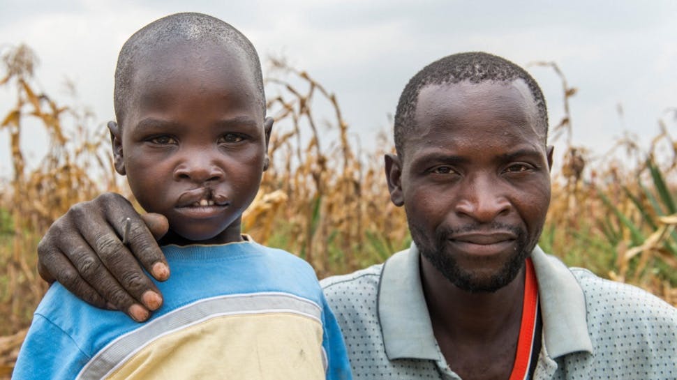 A man and a child with a cleft lip.