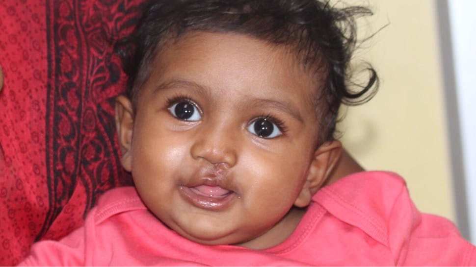 A baby post cleft surgery, smiling