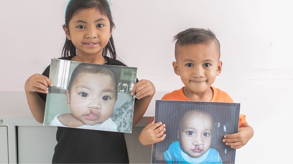 Two children post cleft surgery, holding pictures of themselves as babies