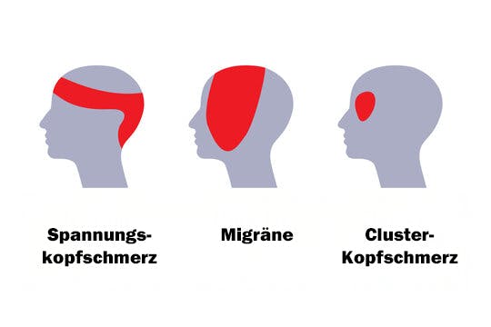 Illustration zu verschiedenen Kopfschmerz-Arten.