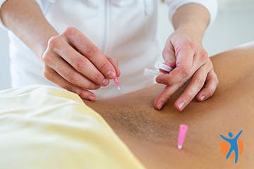 Accupuncture for Osteoarthritis pain Person receiving acupuncture in their back - an effective treatment for osteoarthritis