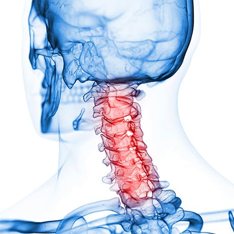 The neck vertebrae where pain occurs The neck vertebrae where pain occurs