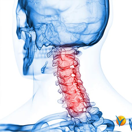 Imagen que muestra las vértebras del cuello donde se produce el dolor - Voltadol 