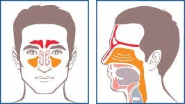 Illustrated schema of sinuses