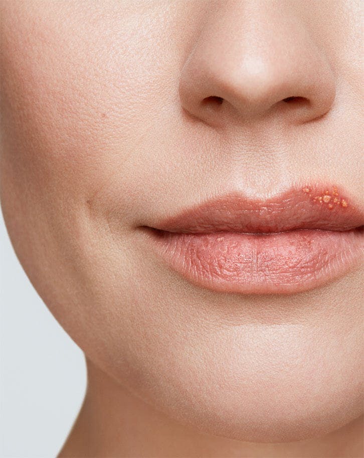 cold sore on woman's lip stage 2 blister stage close up