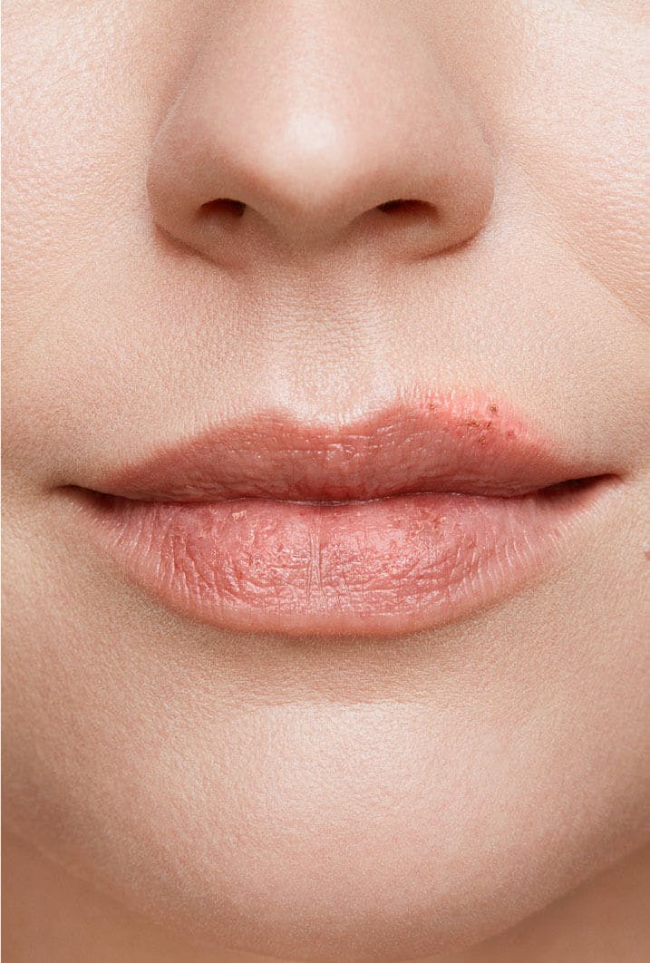 cold sore on woman's lip stage 5 healing stage close up