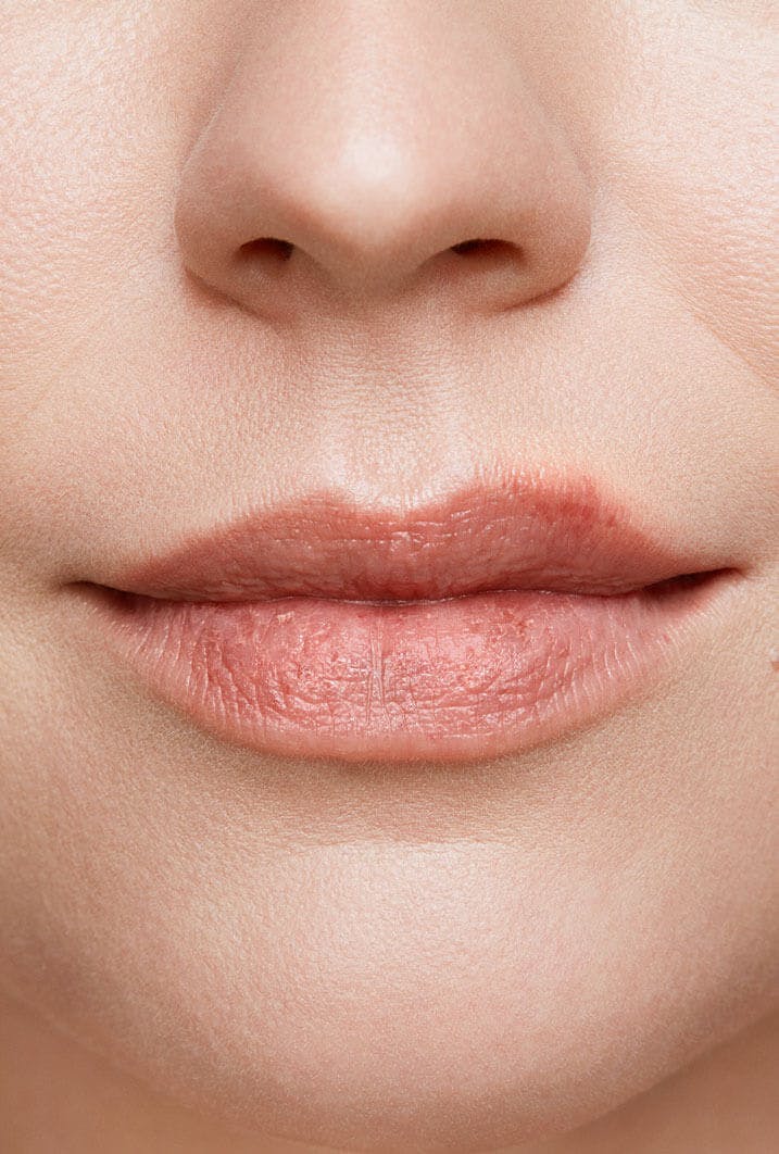 cold sore on woman's lip stage 1 close up tingle stage