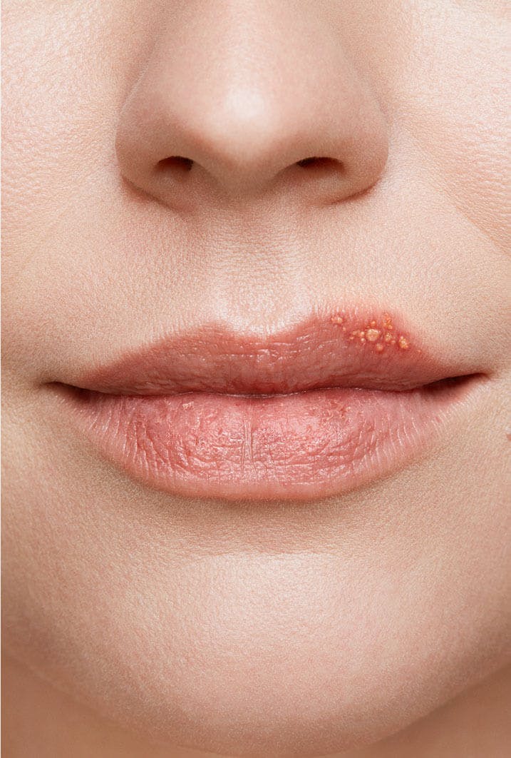 cold sore on woman's lip stage 2 blister stage close up