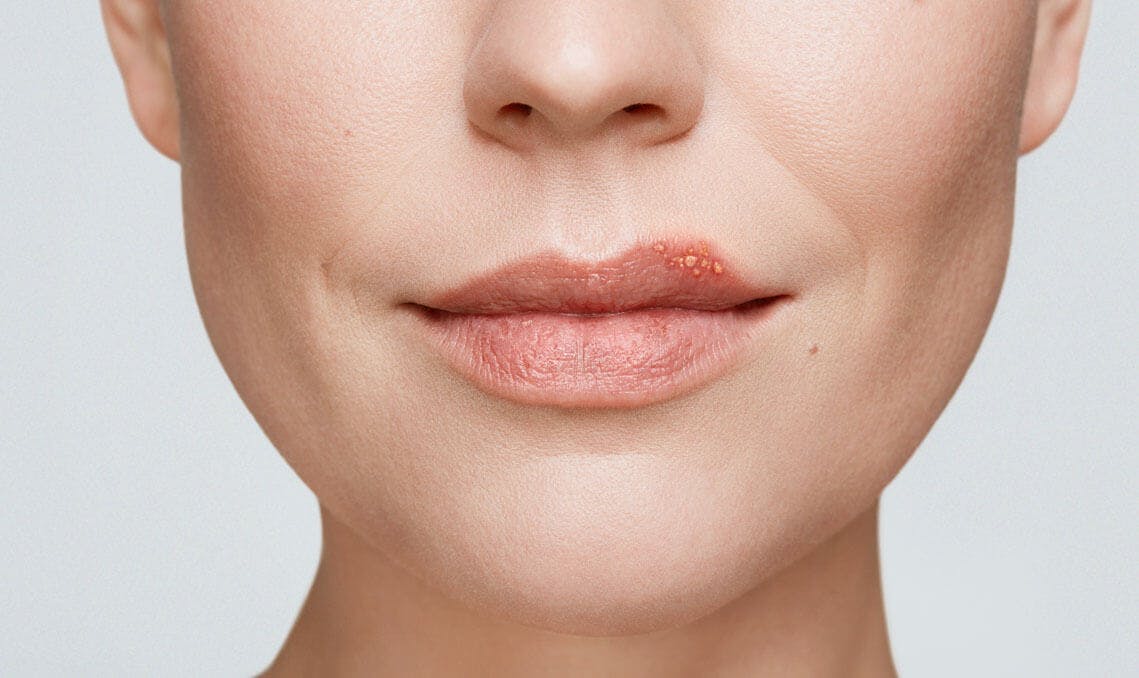 cold sore on woman's lip stage 2 blister stage
