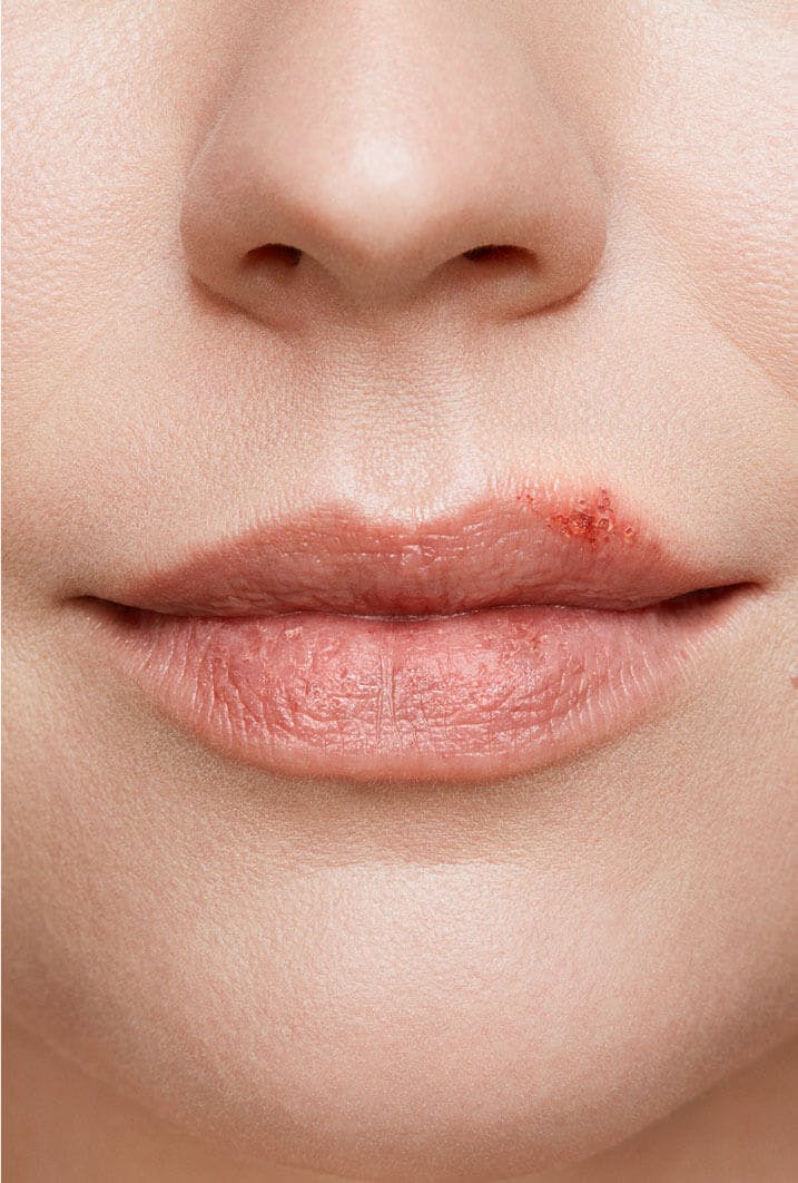 cold sore on woman's lip stage 3 ulcer stage close up