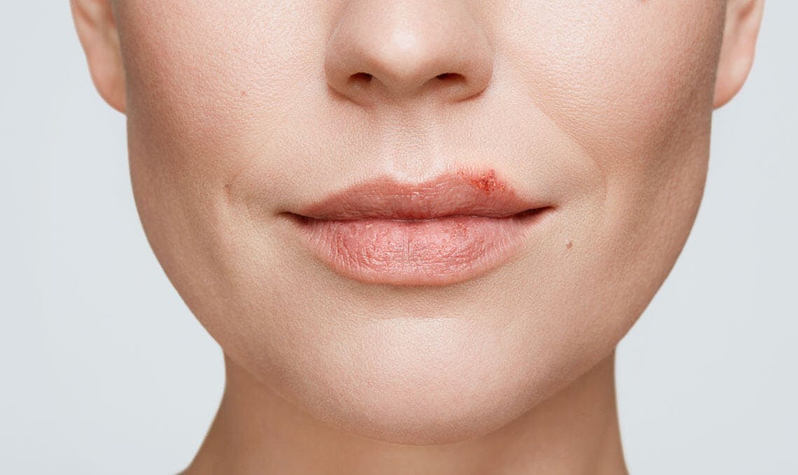 cold sore on woman's lip stage 3 ulcer stage