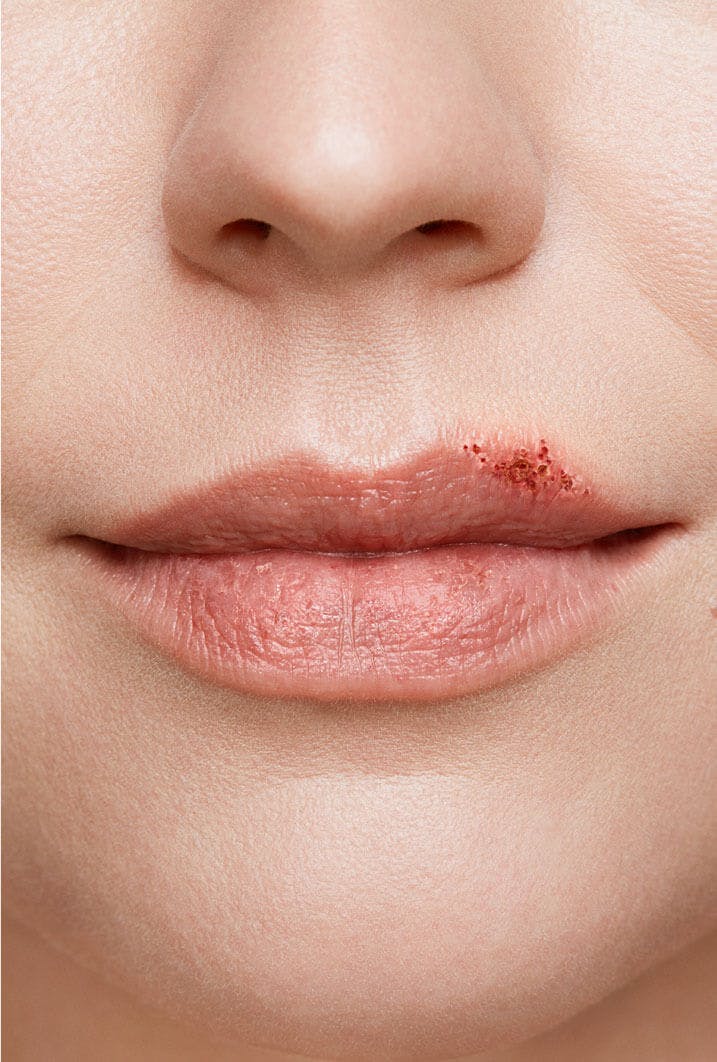 cold sore on woman's lip stage 4 scabbing stage close up