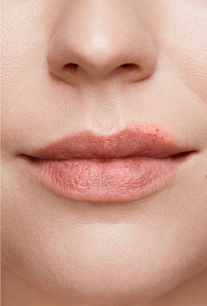 cold sore on woman's lip stage 5 healing stage close up